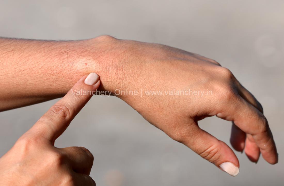 bee-sting