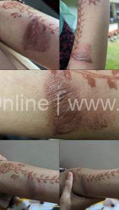 burn-injury-differently-abled