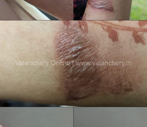 burn-injury-differently-abled