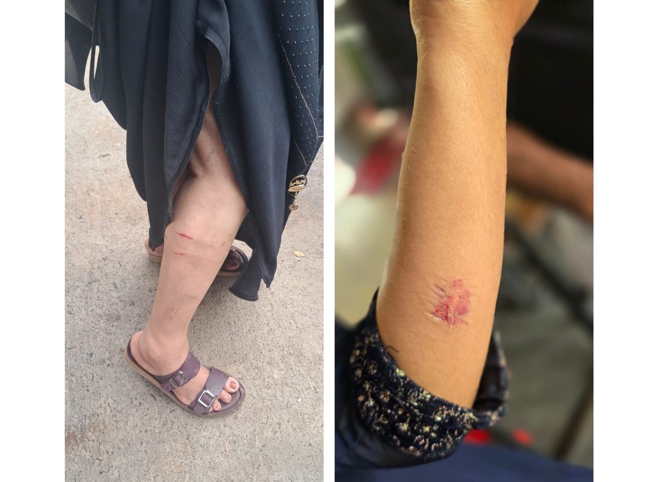 dog-bite-valanchery-oct-2025