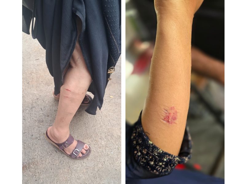 dog-bite-valanchery-oct-2025