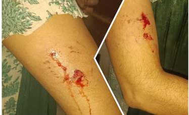 stray-dog-bite-valanchery-april-2026