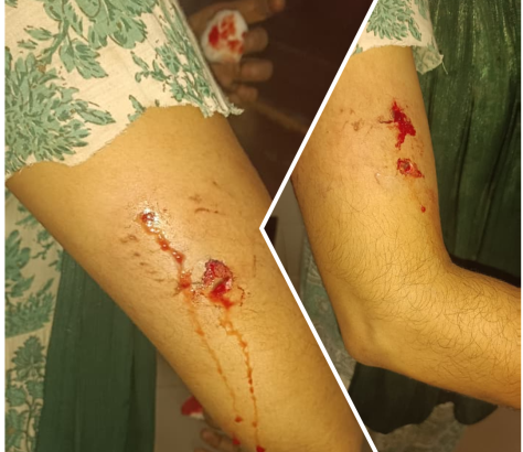 stray-dog-bite-valanchery-april-2026