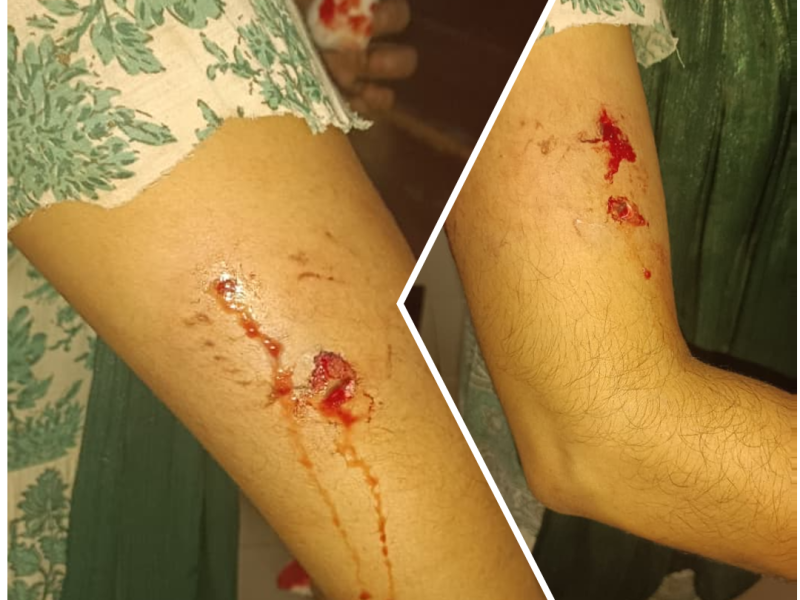 stray-dog-bite-valanchery-april-2026