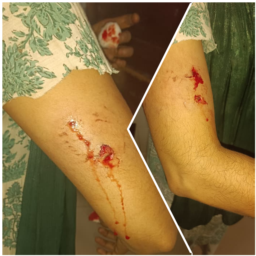 stray-dog-bite-valanchery-april-2026