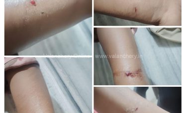 Stray-dog-bite-edayur-2026
