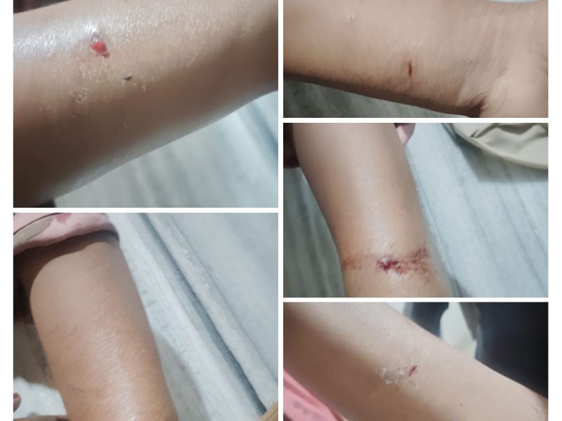 Stray-dog-bite-edayur-2026