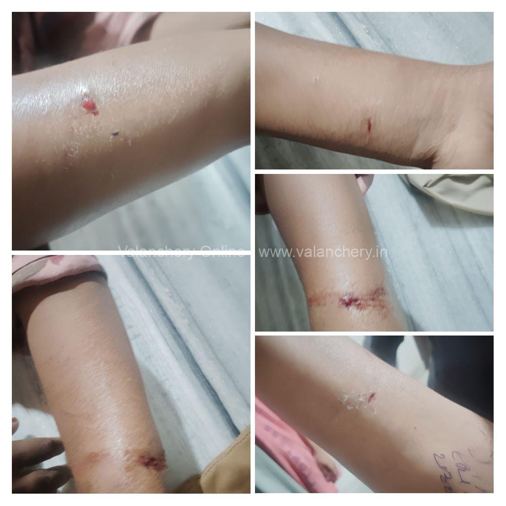 Stray-dog-bite-edayur-2026